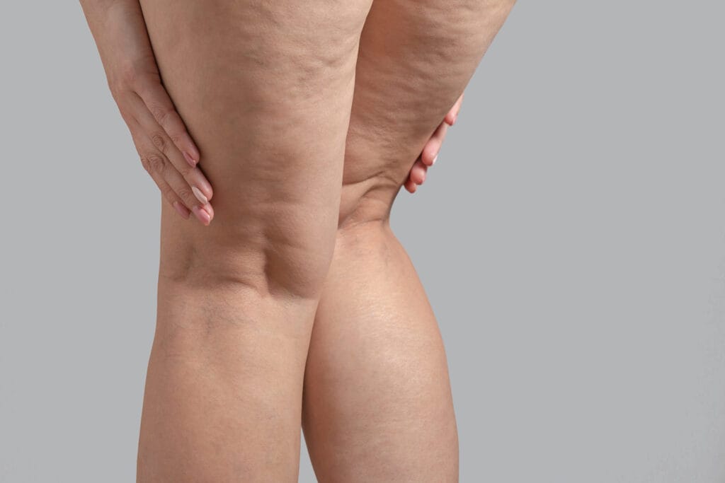 Lipedema não é culpa sua: entenda por que dietas comuns não funcionam para essa condição
