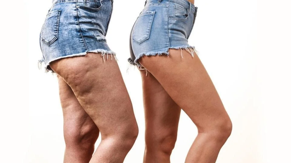 Lipedema não é culpa sua: entenda por que dietas comuns não funcionam para essa condição