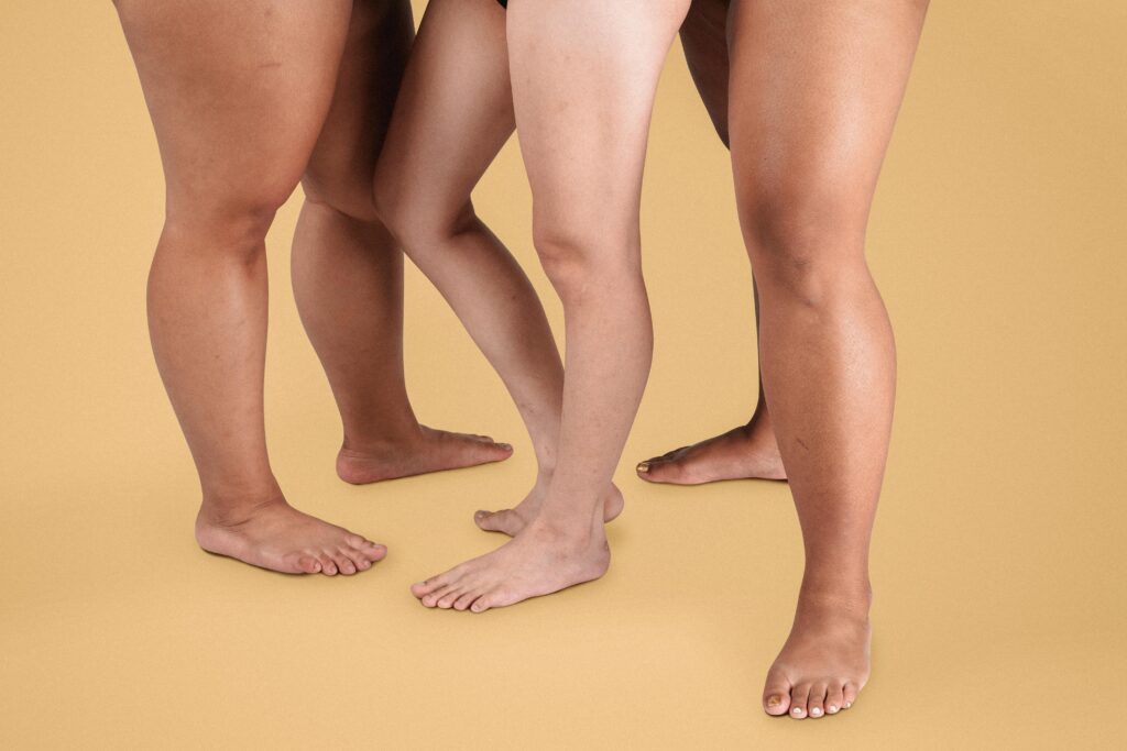 Por onde começar: guia para quem desconfia que pode ter lipedema