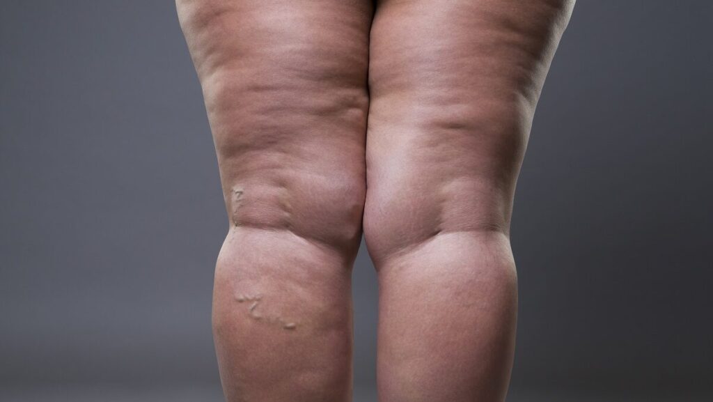 lipedema