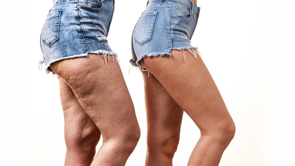 sinais de lipedema