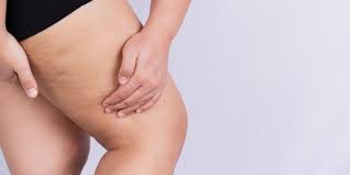 lipedema e autoestima