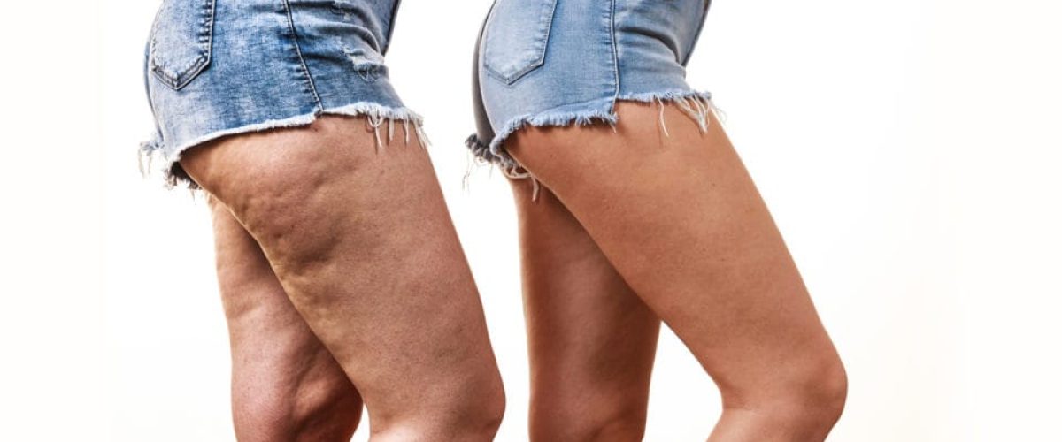 sinais de lipedema
