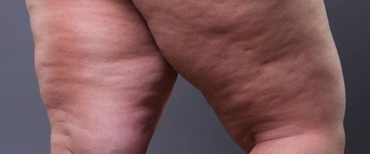 lipedema