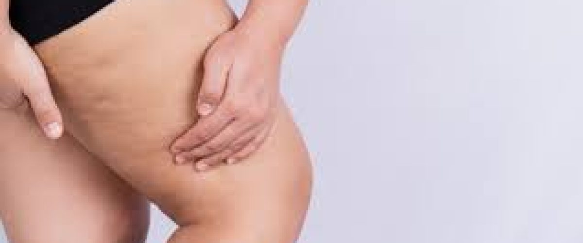 lipedema e autoestima