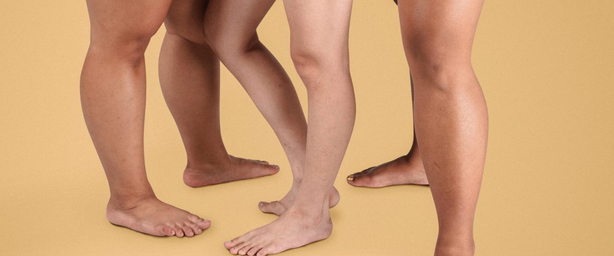 Por onde começar: guia para quem desconfia que pode ter lipedema